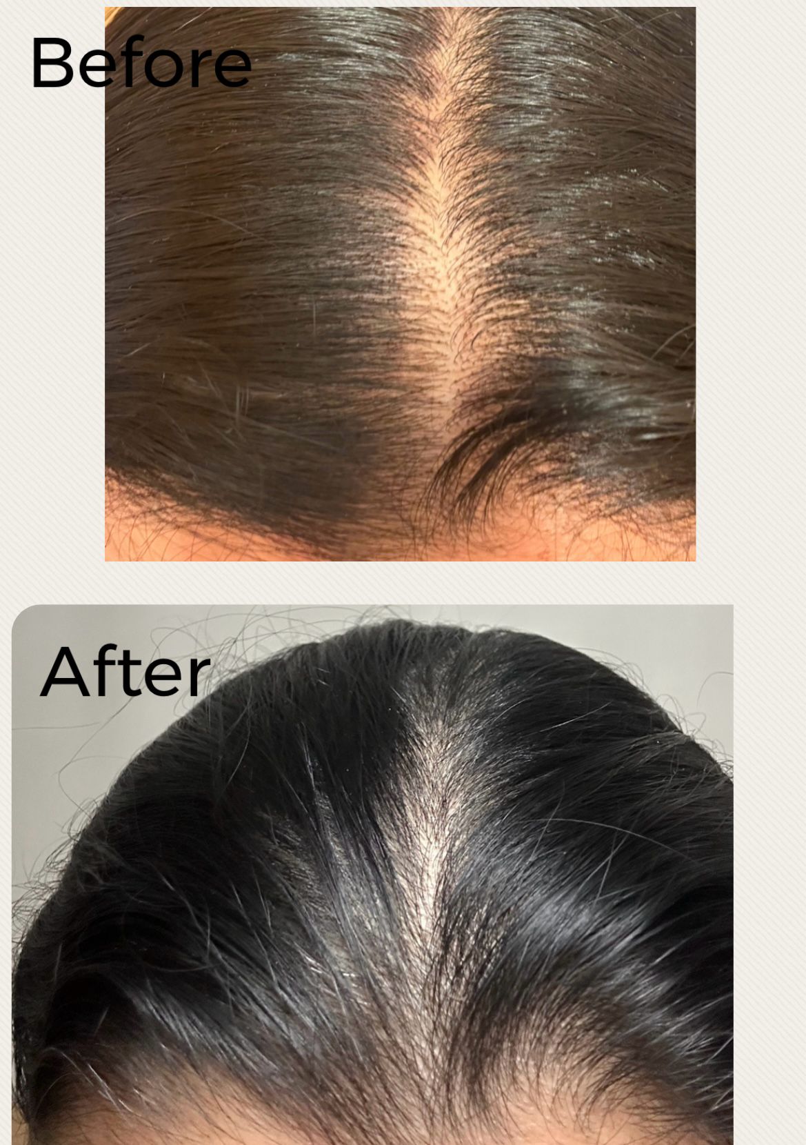 Before & After: Hair Loss Treatment - See Fuller Hair with RENVETA! Hair Density Improvement.