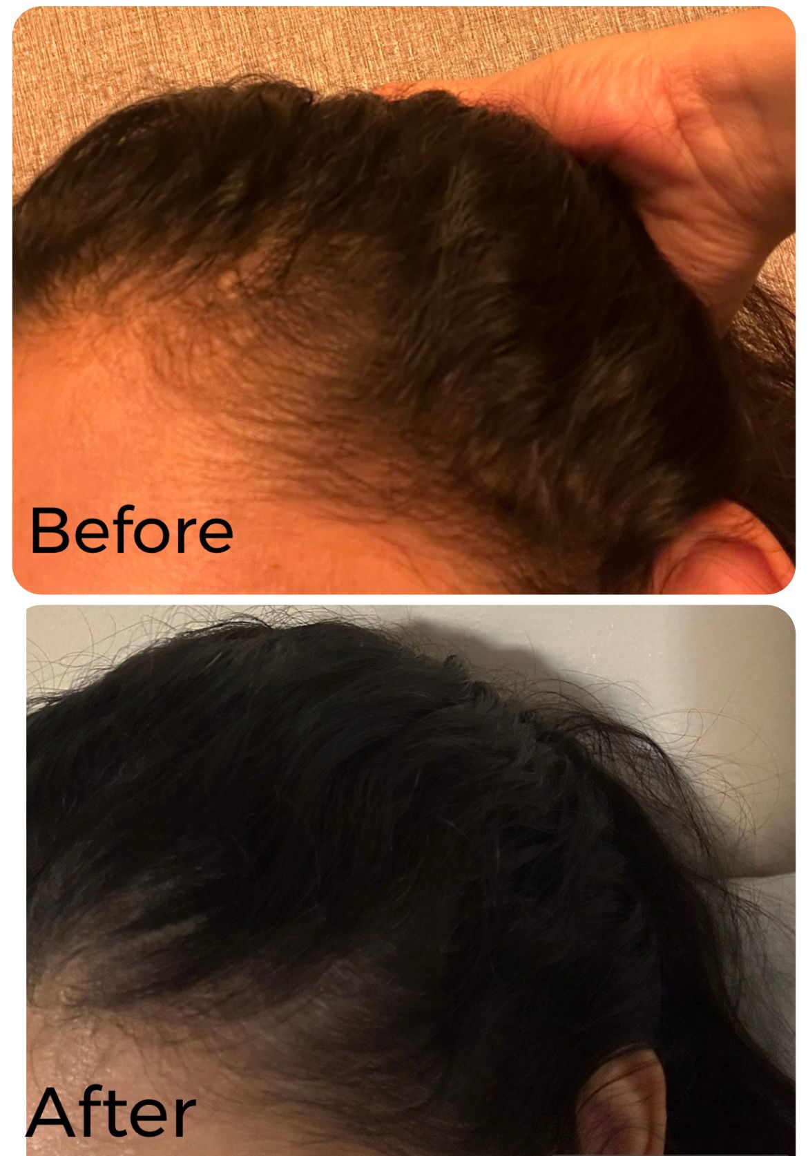Hair Growth Treatment Before & After: Receding Hairline Improvement. See Increased Density!